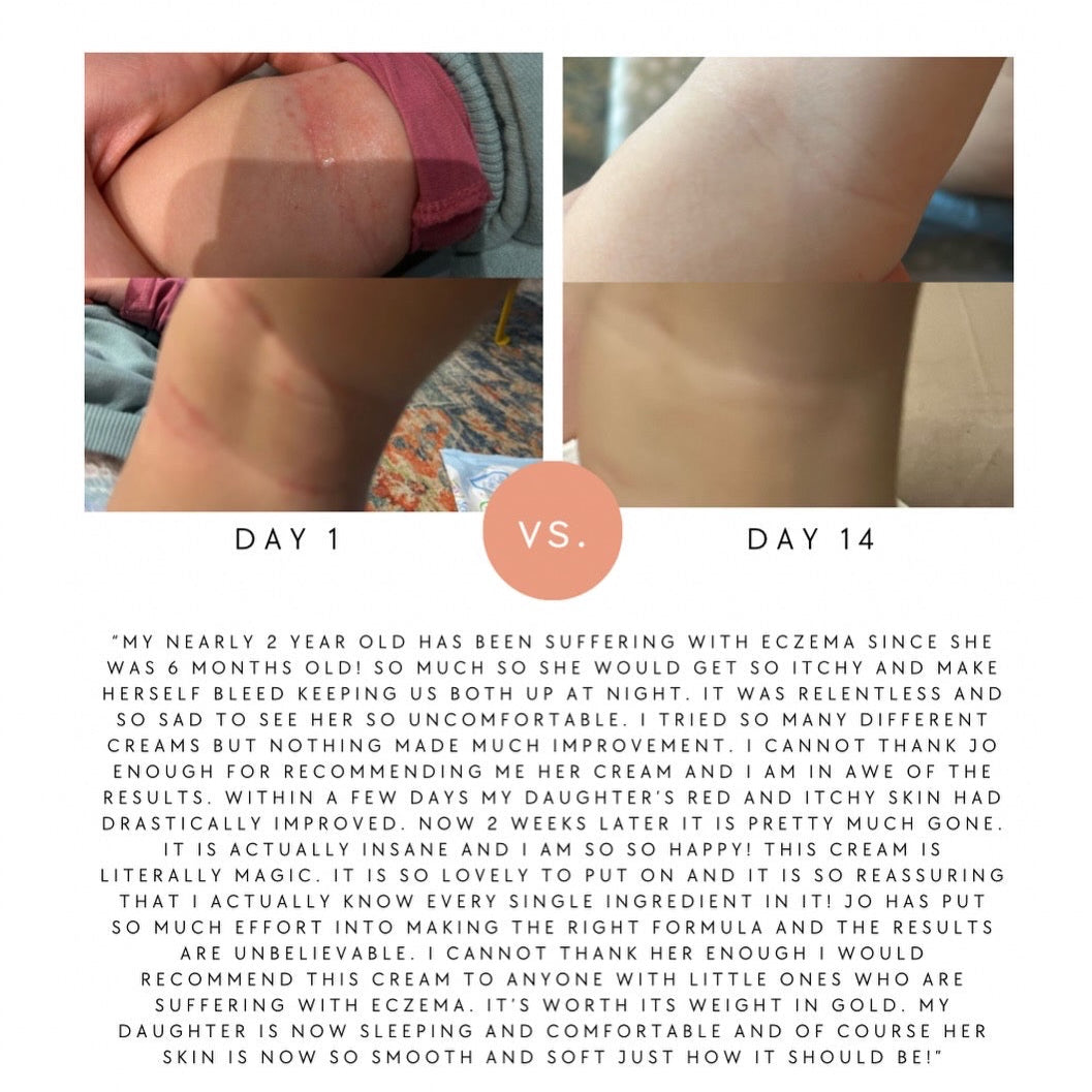 Before and after comparison of a child's skin with eczema using a skincare product.